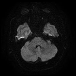 Cerebral amyloid angiopathy (Radiopaedia 28698-28978 Axial DWI 7).jpg