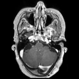 Cerebral amyloid angiopathy (Radiopaedia 29129-29518 Axial T1 C+ 37).jpg