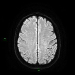 Cerebral amyloid angiopathy (Radiopaedia 77506-89664 Axial DWI 20).jpg
