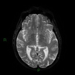 Cerebral amyloid angiopathy (Radiopaedia 77506-89664 Axial DWI 42).jpg