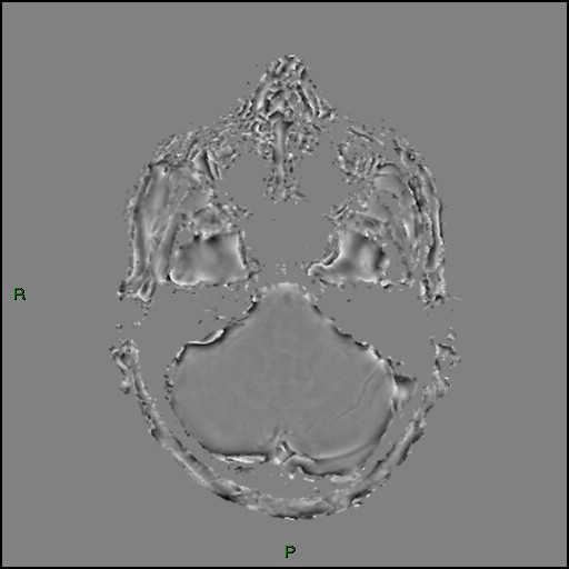 Cerebral amyloid angiopathy (Radiopaedia 77506-89664 H 27).jpg