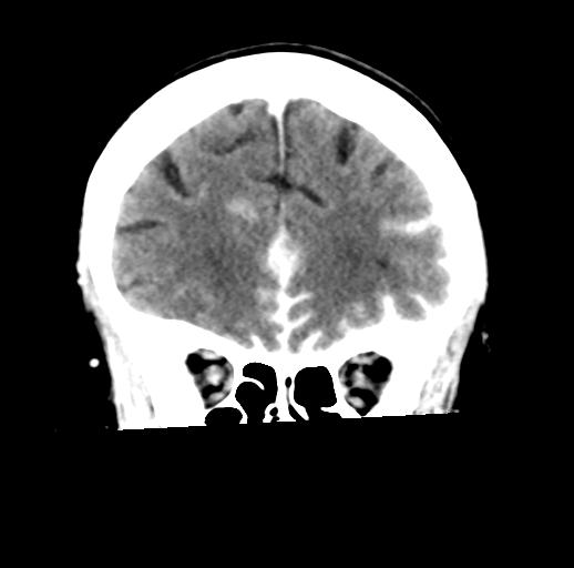 File:Cerebral aneurysm with rupture (Radiopaedia 29933-30460 Coronal non-contrast 10).jpg