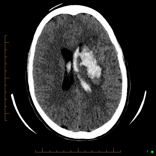 Cerebral arteriovenous malformation (AVM) (Radiopaedia 78162-90706 Axial non-contrast 40).jpg