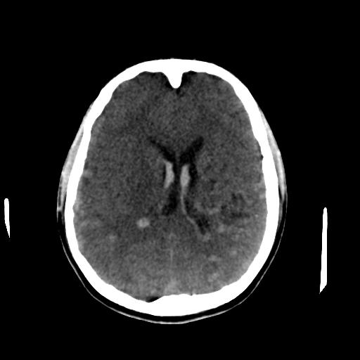 Cerebral arteriovenous malformation (Radiopaedia 28518-28759 Axial non-contrast 43).jpg