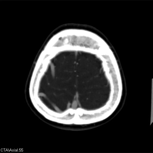 File:Cerebral arteriovenous malformation (Radiopaedia 28518-28759 B 55).jpg