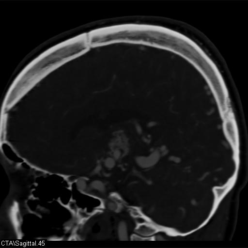 Cerebral arteriovenous malformation (Radiopaedia 28518-28759 D 42).jpg