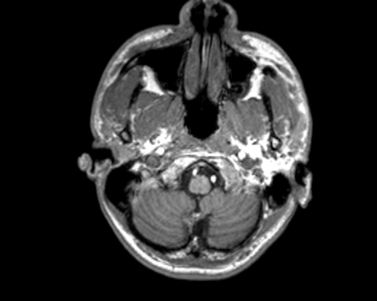 Cerebral arteriovenous malformation (Radiopaedia 30198-30813 Axial T1 50).jpg