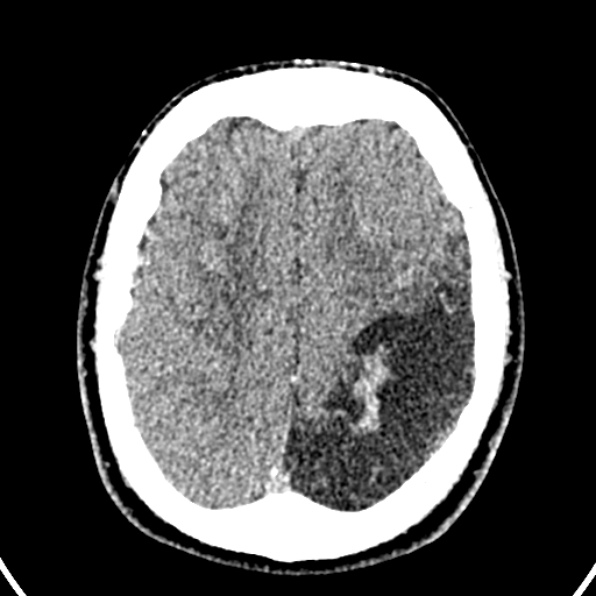 File:Cerebral arteriovenous malformation (Radiopaedia 37182-39012 Axial non-contrast 36).jpg