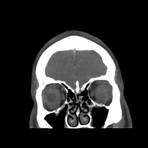 Cerebral arteriovenous malformation (Radiopaedia 39259-41505 E 10).png