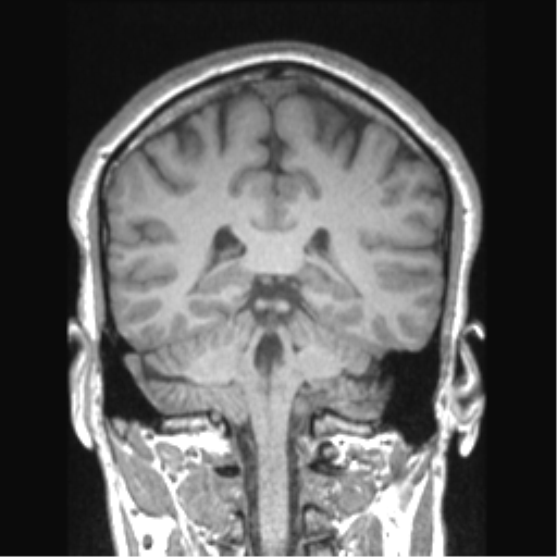 Cerebral arteriovenous malformation (Radiopaedia 39259-41506 Coronal T1 36).png