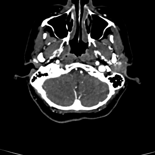 Cerebral arteriovenous malformation (Radiopaedia 73830-84645 Axial C+ delayed 82).jpg