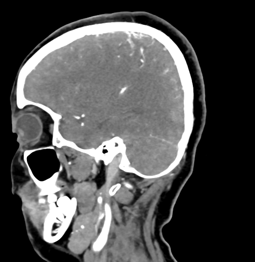 Cerebral arteriovenous malformation (Radiopaedia 73830-84645 D 67).jpg