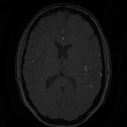 Cerebral arteriovenous malformation (Radiopaedia 74411-85654 Axial MRA 88).jpg