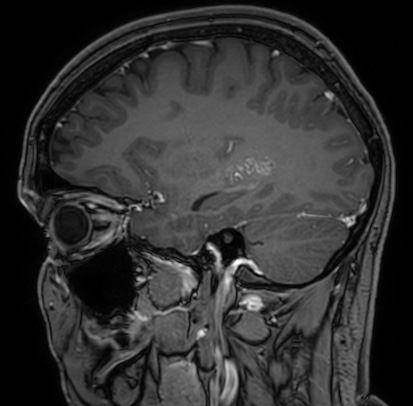Cerebral arteriovenous malformation (Radiopaedia 74411-85654 Sagittal T1 C+ 38).jpg