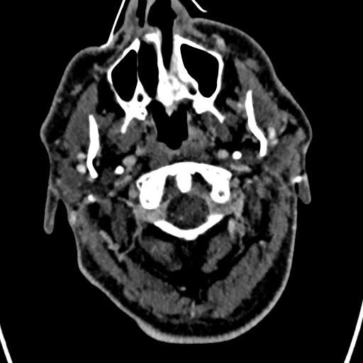 Cerebral arteriovenous malformation (Radiopaedia 78188-90746 Axial C+ delayed 5).jpg