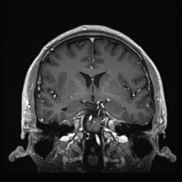 Cerebral arteriovenous malformation (Radiopaedia 84015-99245 Coronal T1 C+ 74).jpg