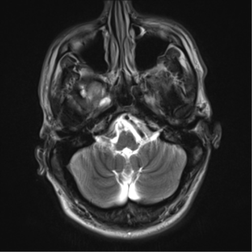 File:Cerebral arteriovenous malformation - huge (Radiopaedia 35734-37272 Axial T2 4).png