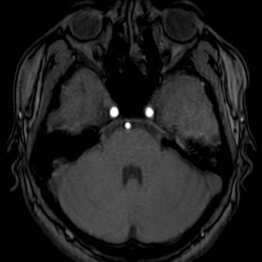 Cerebral arteriovenous malformation at posterior body of corpus callosum (Radiopaedia 74111-84925 Axial MRA 51).jpg