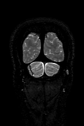 Cerebral arteriovenous malformation at posterior body of corpus callosum (Radiopaedia 74111-84925 Coronal T2 165).jpg