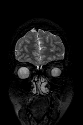 Cerebral arteriovenous malformation at posterior body of corpus callosum (Radiopaedia 74111-84925 Coronal T2 21).jpg