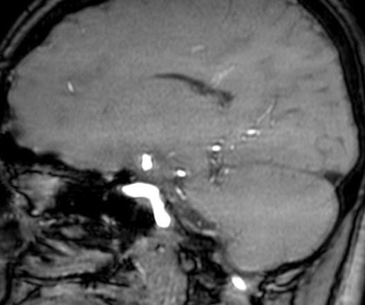 Cerebral arteriovenous malformation at posterior body of corpus callosum (Radiopaedia 74111-84925 J 152).jpg