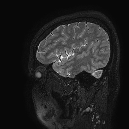 Cerebral arteriovenous malformation at posterior body of corpus callosum (Radiopaedia 74111-84925 Sagittal T2 113).jpg