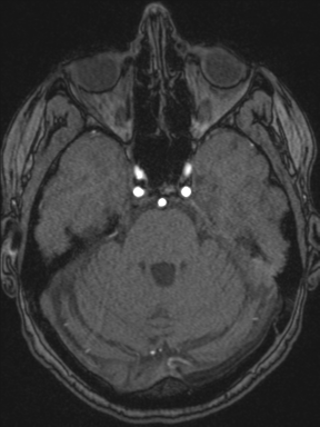Cerebral arteriovenous malformation with hemorrhage (Radiopaedia 34422-35737 Axial MRA 24).png