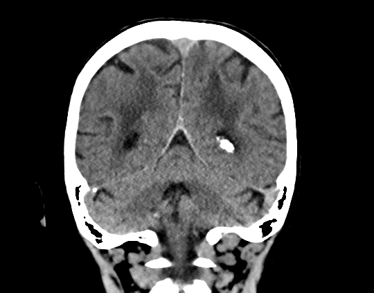 Cerebral arteriovenous malformation with lobar hemorrhage (Radiopaedia 44725-48510 Coronal non-contrast 35).png