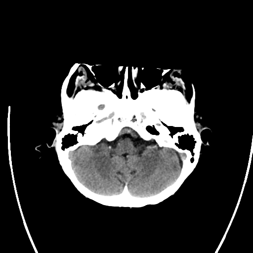 File:Cerebral arteriovenous malformation with lobar hemorrhage (Radiopaedia 44725-48512 Axial non-contrast 11).png