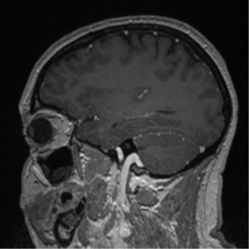 Cerebral cavernoma and development venous anomaly (Radiopaedia 37603-39482 Sagittal T1 C+ 31).png
