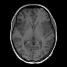 Cerebral cavernous venous malformation (Radiopaedia 70008-80021 Axial T1 37).jpg