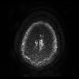 Cerebral cavernous venous malformation (Zabramski type II) (Radiopaedia 85511-101198 Axial DWI 63).jpg