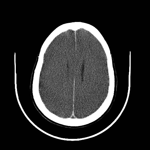 File:Cerebral edema (evolution in time) (Radiopaedia 19418-19439 non-contrast 65).jpg