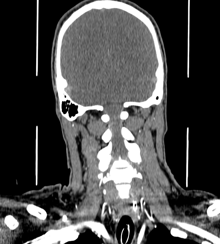 Cerebral edema in an overdose patient (Radiopaedia 72005-82539 B 122).jpg