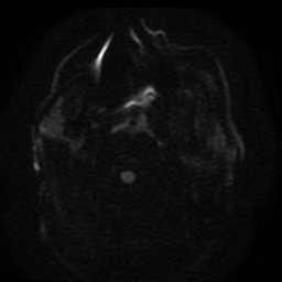 File:Cerebral embolic infarcts (embolic shower) (Radiopaedia 49837-55108 Axial DWI 96).jpg