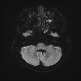 File:Cerebral embolic infarcts (embolic shower) (Radiopaedia 72391-82921 Axial DWI 36).jpg