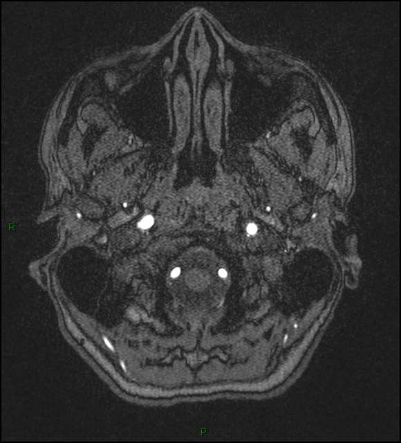 Cerebral fat embolism (Radiopaedia 35022-36525 Axial TOF 6).jpg