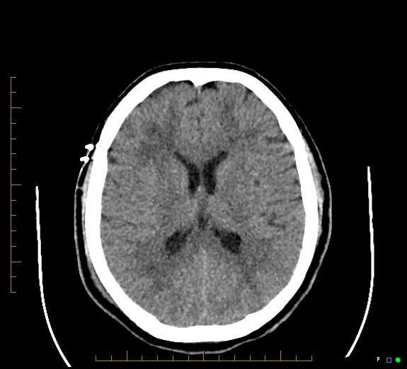 Cerebral fat embolism (Radiopaedia 85521-101220 Axial non-contrast 37).jpg