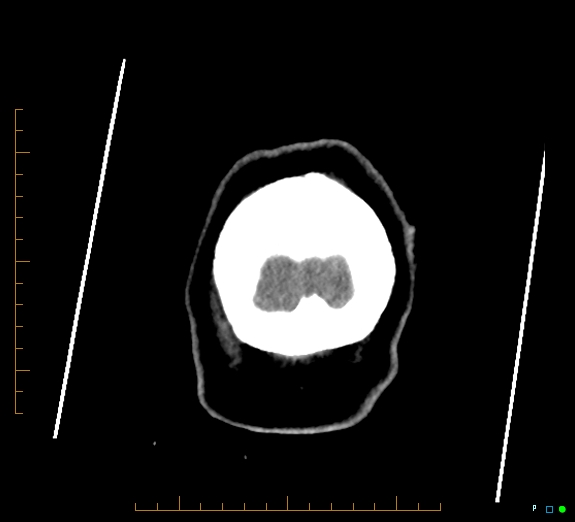 Cerebral fat embolism (Radiopaedia 85521-101220 Coronal non-contrast 61).jpg