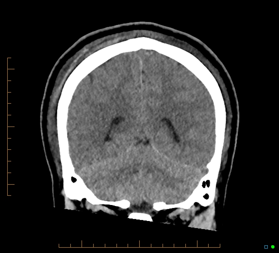Cerebral fat embolism (Radiopaedia 85521-101224 Coronal non-contrast 45).jpg