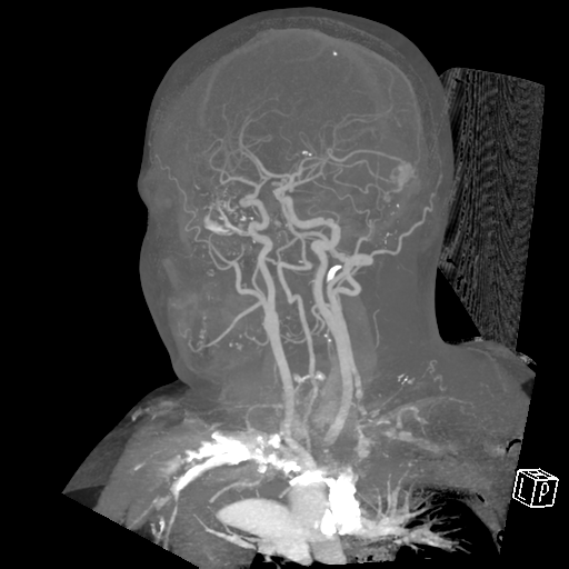 File:Cerebral hemorrhage secondary to arteriovenous malformation (Radiopaedia 33497-34571 A 6).png