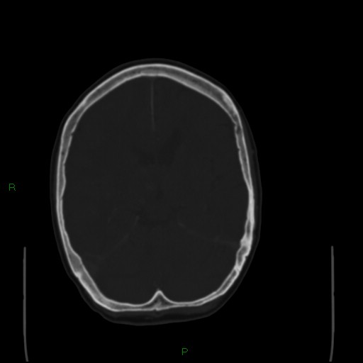 Cerebral metastases - breast primary (Radiopaedia 77653-89857 Axial bone window 60).jpg