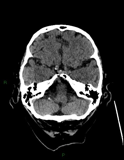 Cerebral metastases - ependymal and parenchymal (Radiopaedia 79877-93131 Axial non-contrast 14).jpg