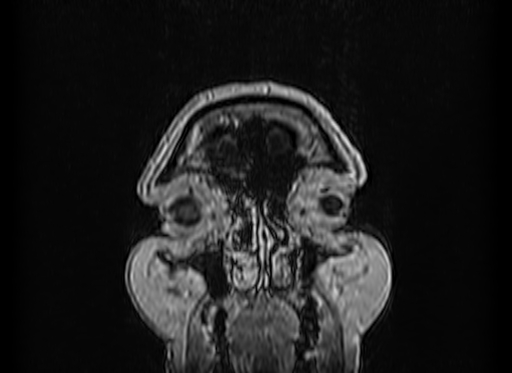 File:Cerebral metastases from lung cancer with amyloid angiopathy and cerebellopontine angle meningioma (Radiopaedia 74306-85191 Coronal T1 C+ 1).jpg