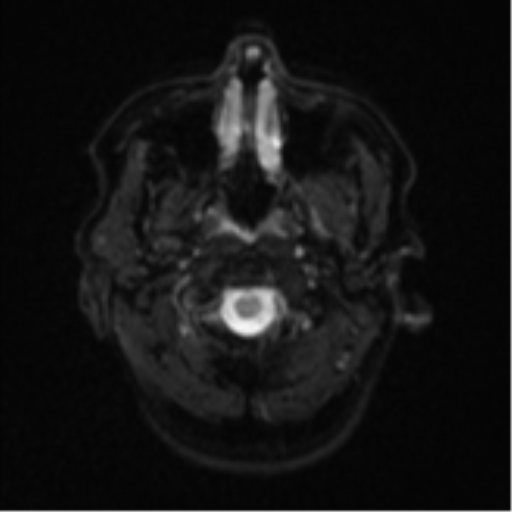Cerebral metastases mimicking abscesses (Radiopaedia 45841-50131 Axial DWI 3).png