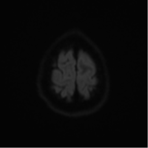 Cerebral metastases mimicking abscesses (Radiopaedia 45841-50131 Axial DWI 54).png
