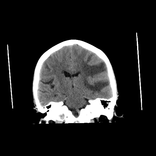 File:Cerebral metastasis (Radiopaedia 46744-51247 Axial non-contrast 1).png