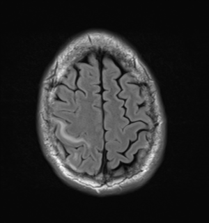 File:Cerebral metastasis - melanoma (Radiopaedia 54718-60954 Axial FLAIR 25).png