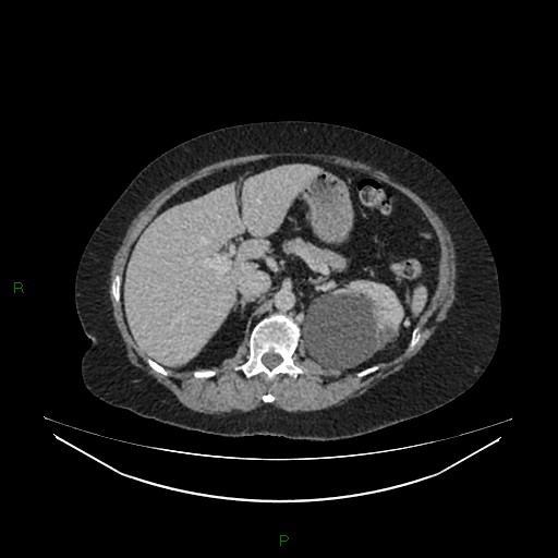 Cerebral metastasis from renal cell carcinoma (Radiopaedia 82306-96378 A 53).jpg