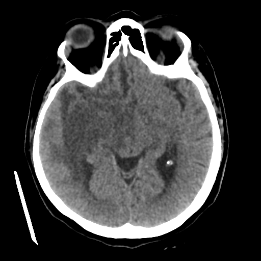 File:Cerebral metastasis to basal ganglia (Radiopaedia 81568-95412 Axial non-contrast 29).png
